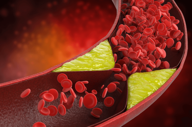 Vasos sanguíneos: Descubra cómo limpiar las arterias de forma natural