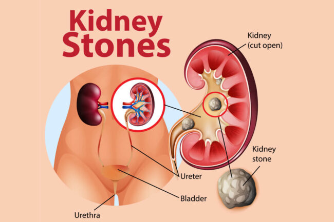 CRUSH Kidney Stone Pain FAST: 3 Doc-Approved Strategies