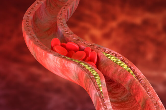 Understanding LDL: Strategies to Combat the Dangers of Bad Cholesterol