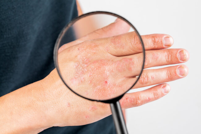 Más que un problema estético: La Dermatitis Seborreica y su Impacto