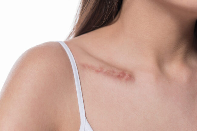 Scars: 10 Remedies to Erase It Naturally