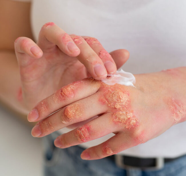 Psoriasis Relief: Can You Finally Stop the Flares?