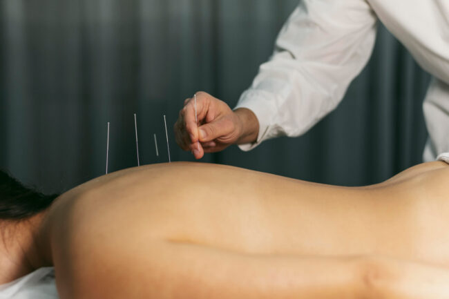 Tired of Counting Calories? Explore Acupuncture for Sustainable Weight Management