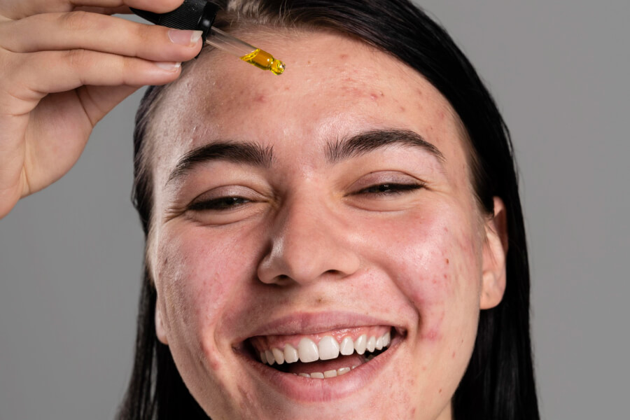 The Amazing Benefits of CBD For Your Acne-Prone Skin