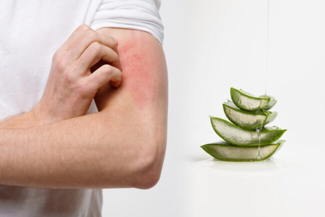 Aloe Vera and Scabies: Benefits and How to Apply It Correctly