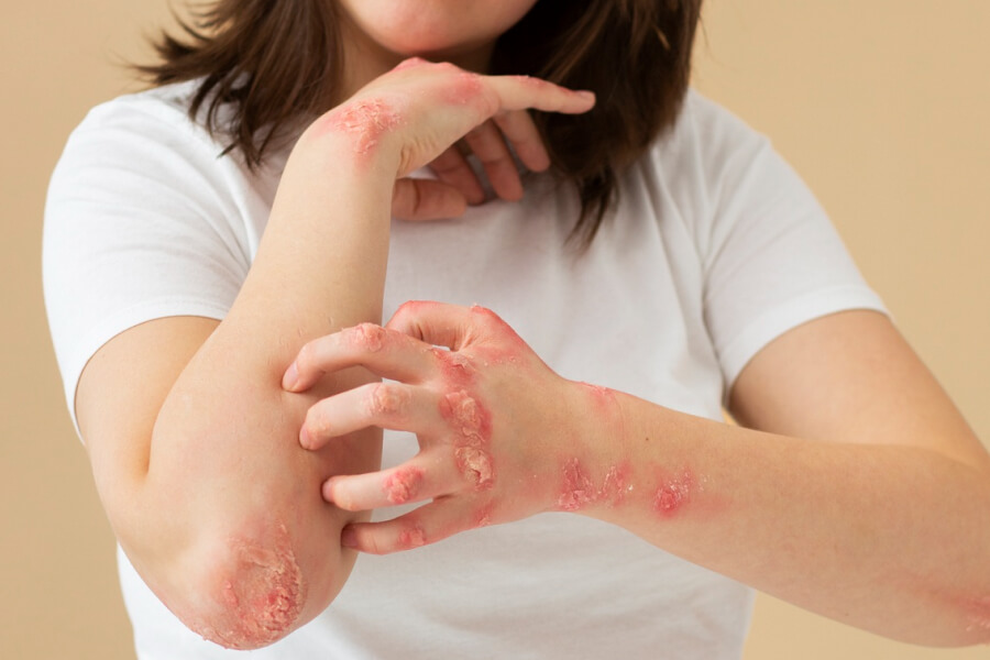 Scabies on the Skin