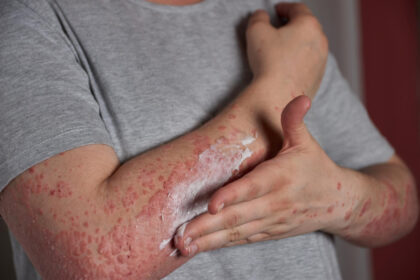 Natural Treatments for Scabies