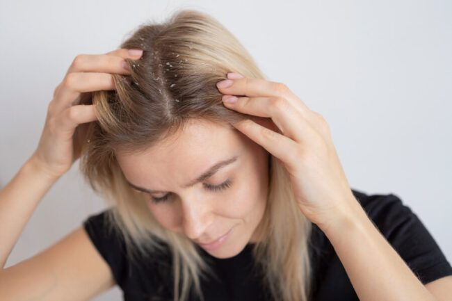 Oils to Remove Dandruff