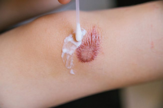 Burn Injury: 10 Ways to Manage Degrees of Burns for Skin