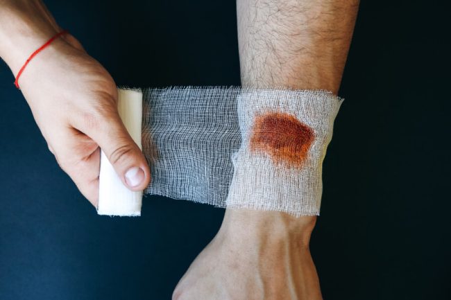 Burn Injury: 10 Ways to Manage Degrees of Burns for Skin