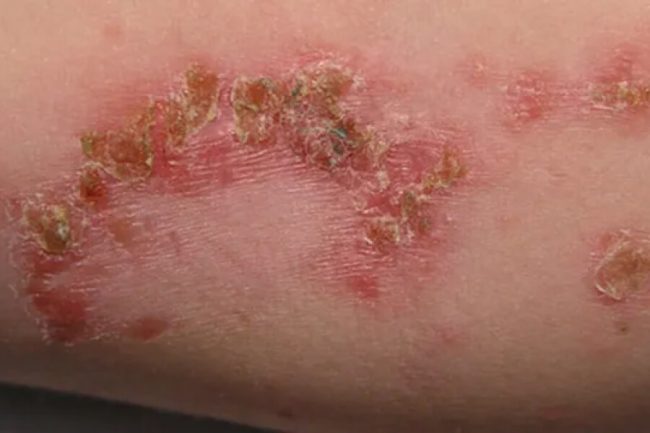 Impetigo: Contagious Skin Infection, Early Signs