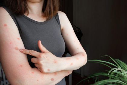 How to Treat Hives Naturally with Herbal Remedies