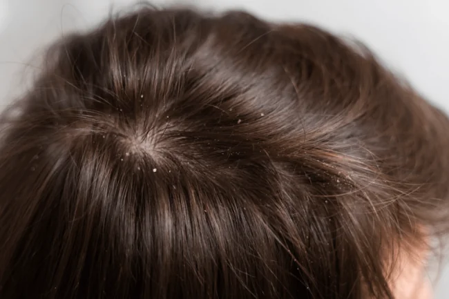 Is Dandruff Ruining Your Hair? Here’s the Natural Oil Fix!