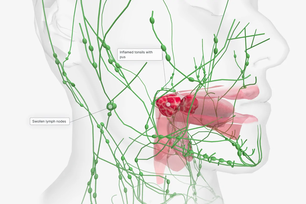 swollen lymph nodes