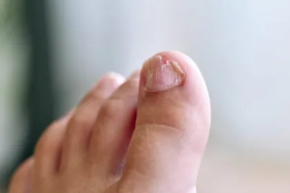 toenail fungus