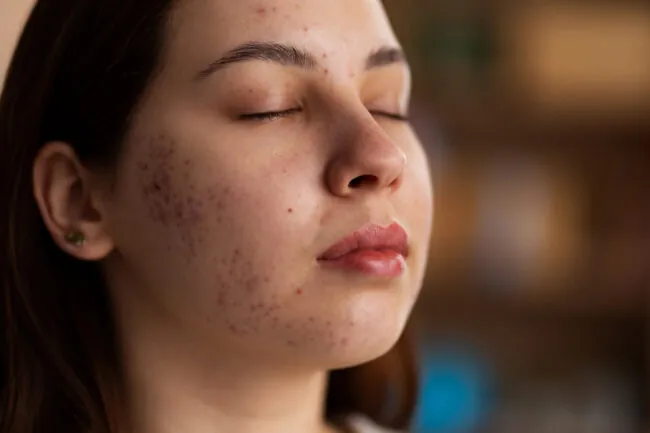 5 Rosacea Hacks to Calm Your Angry Skin (Naturally!)