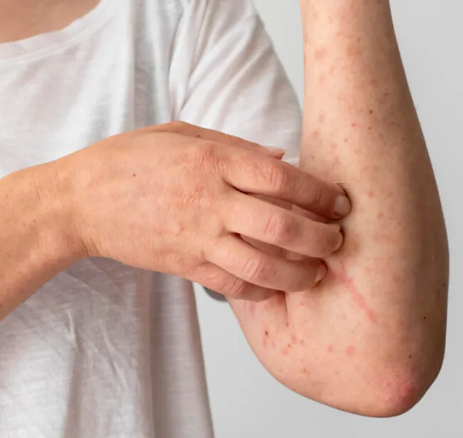 Understanding Eczema: Symptoms, Causes & Treatments