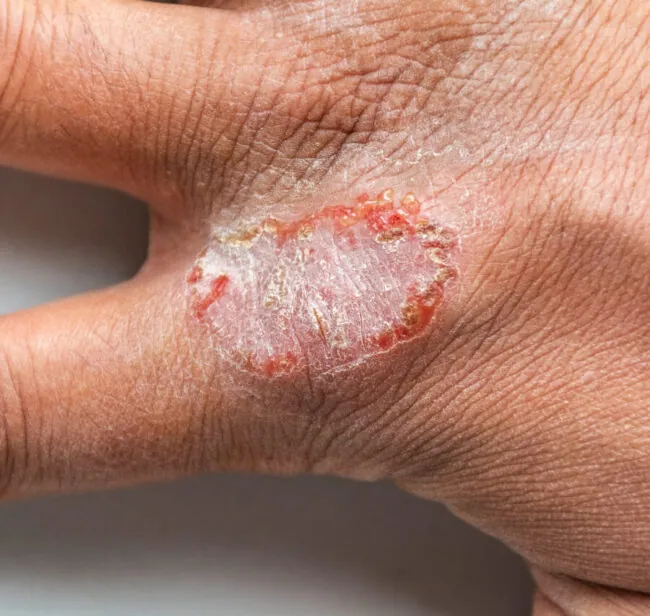 Catch These 10 Signs of a Fungal Skin Infection Before It Spreads