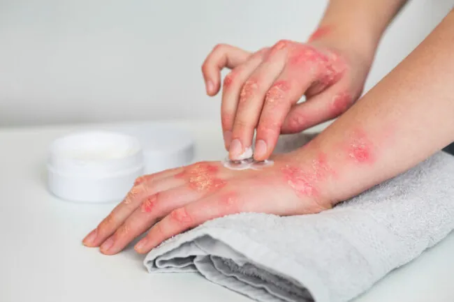 How to Prevent the Spread of Scabies on the Skin: 4 Tips