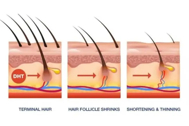 DHT y Pérdida de Cabello: Hombres vs. Mujeres