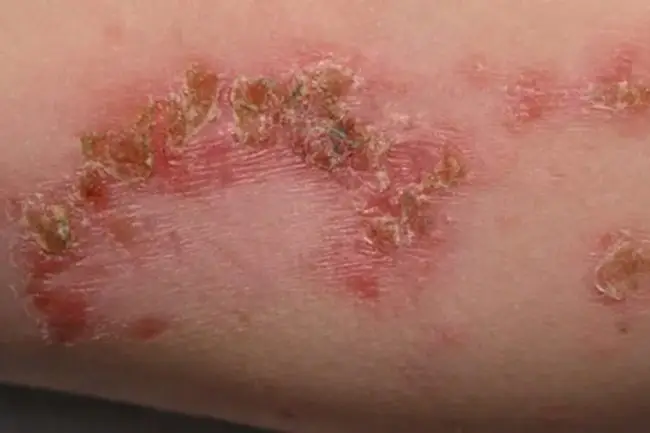 Impetigo: Contagious Skin Infection, Early Signs