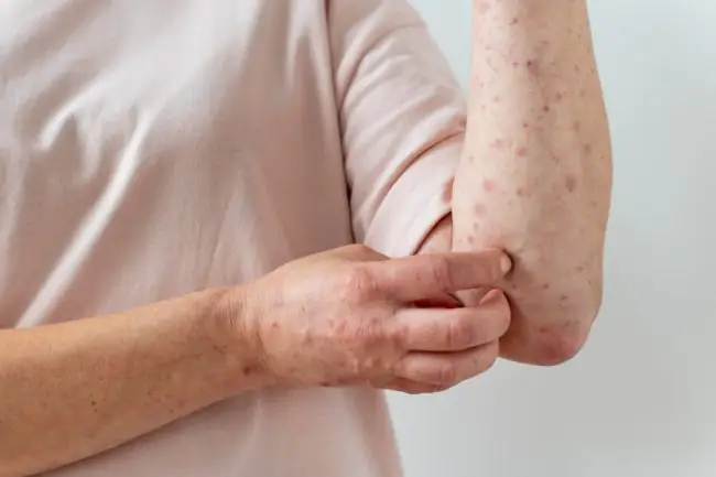 How to Identify Scabies in Comparison to Allergy?