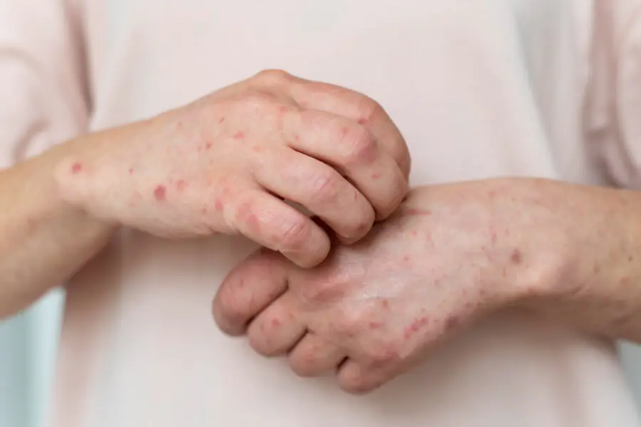 How to Identify Scabies in Comparison to Allergy?